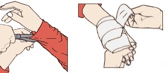 popaleniny